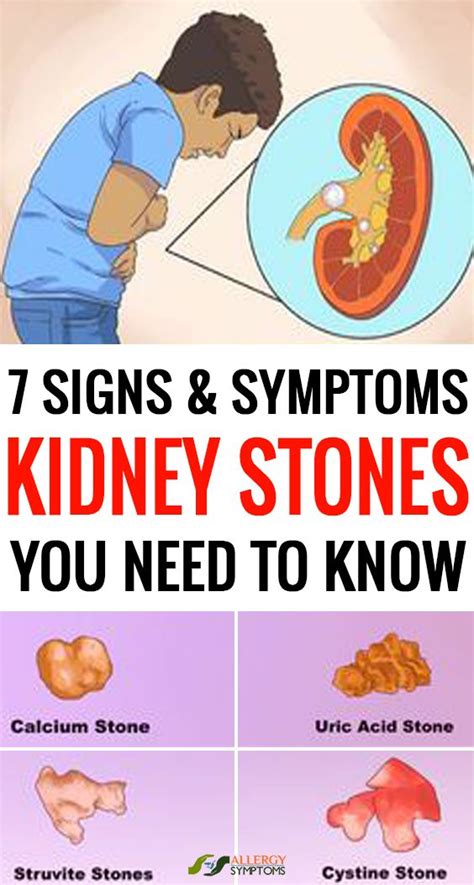 7 Signs And Symptoms Of Kidney Stones In 2020 Kidney Stones Symptoms