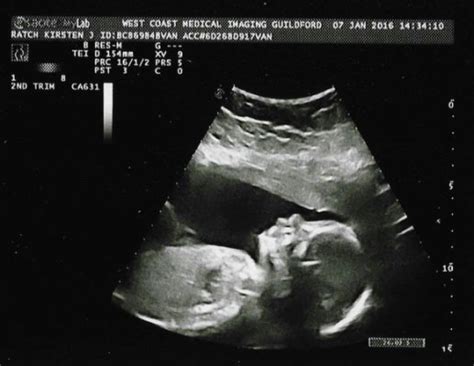 23 Week Ultrasound Gender Babycenter