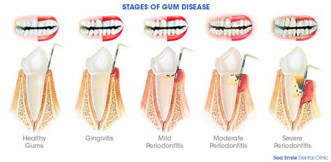Periodontal Disease Drummoyne Dental Practice