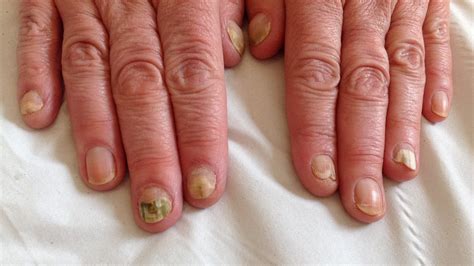 Finger Nail Infections Are They Fungal Candida Or Bacterial