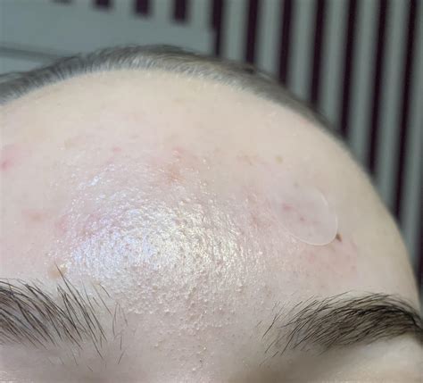 Skin Concerns How Do I Get Rid Of This Texture On My Forehead
