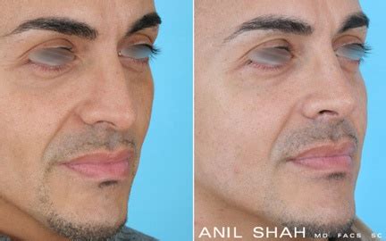 A trained provider can do the procedure in 15 minutes or less. Hispanic Male Rhinoplasty Patient 1- 3/4 view | Facial ...