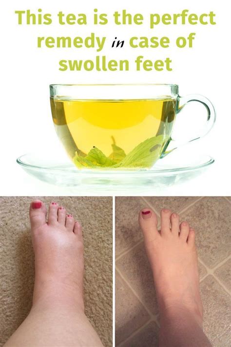 This Tea Is The Perfect Remedy In Case Of Swollen Feet Water