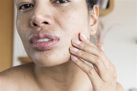 You're using a perfumed moisturiser and applying it when your skin is dry. Dry Skin Around the Mouth and Chin: Causes, Treatments and ...