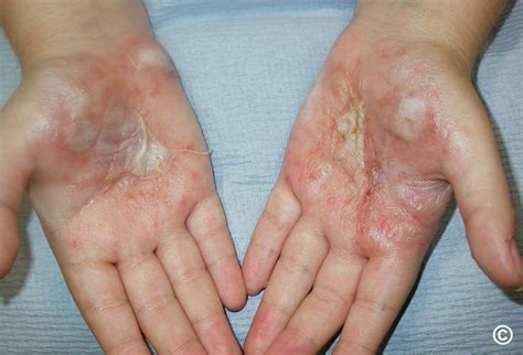 Eczema Hand And Foot