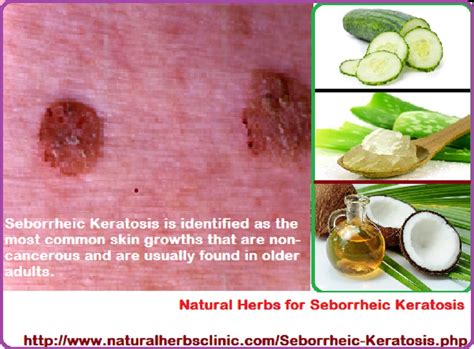 C Natural Herbs For Seborrheic Keratosis Natural Herbs Clinic Yu