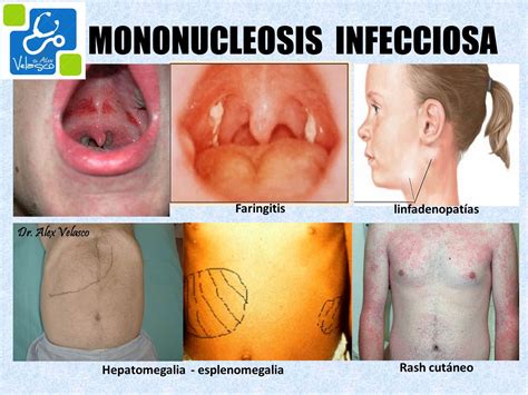 Mononucleosis Infecciosa La Enfermedad Del Beso ~ Dr