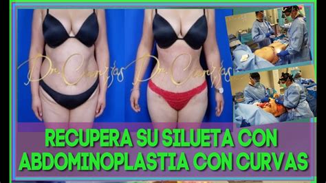 Abdominoplastia Antes Y Despu S Wilberto Cortes M D