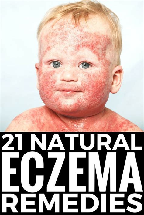 Itching Caused By Eczema Dry Skin Psoriasis And Allergies How To Stop