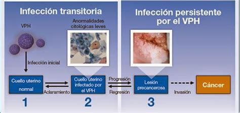 Virus Del Papiloma Humano Vph
