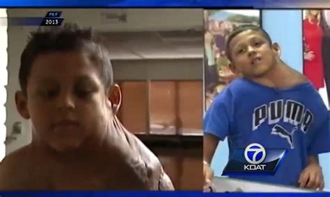 10 Year Old Boy Arrives In Us From Mexico Has Neck Tumor Removed