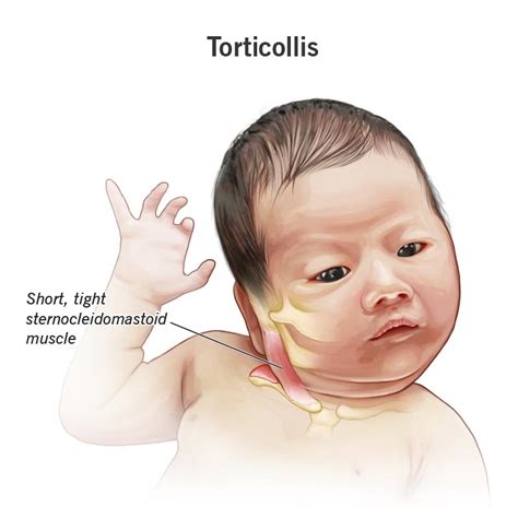 Torticollis Wryneck Symptoms Causes Treatment