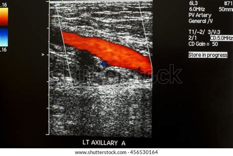 Left Axillary Artery Doppler Ultrasound Stock Photo Edit Now 456530164