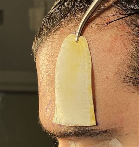 Plastic Surgery Case Study Left Male Forehead Augmentation With Eptfe