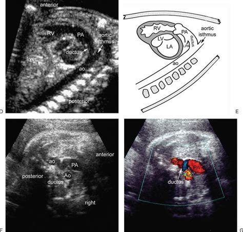 Ultrasound Evaluation Of The Fetal Heart Radiology Key Ultrasound
