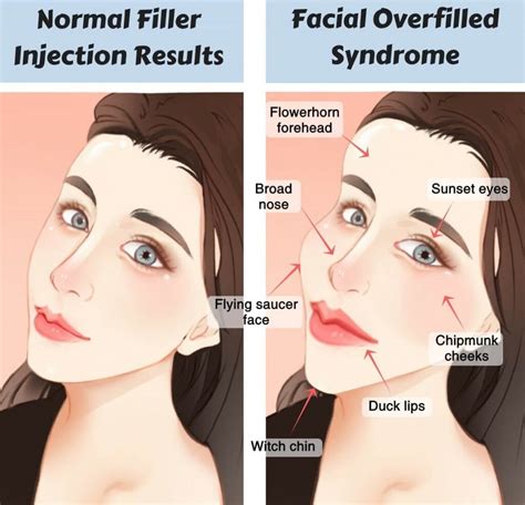 How To Avoid And Handle Fillers Gone Wrong — Lazaderm Laser And Aesthetics