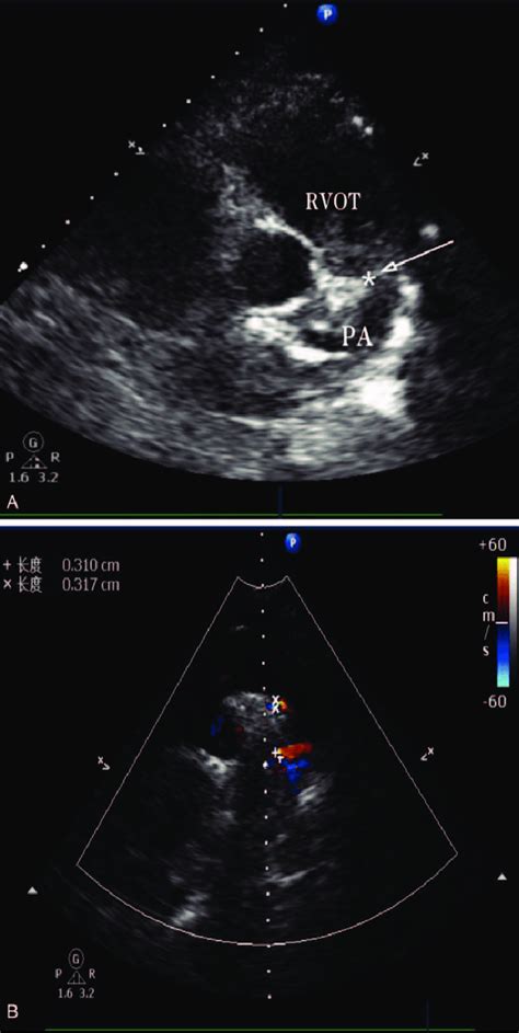 A Transthoracic Echocardiogram Parasternal Short Axis View Shows The