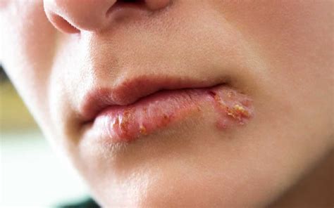 I frequently wanted to just rip my. Oral Herpes: Signs, Risks & How to Get Rid of Cold Sores ...