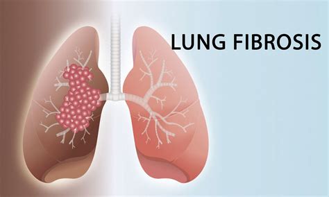 Cystic Fibrosis Lungs Vs Healthy Lungs