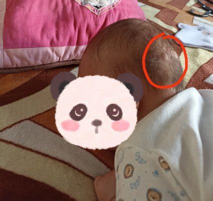 Mi bebé tiene una bolita detrás de la cabeza BabyCenter