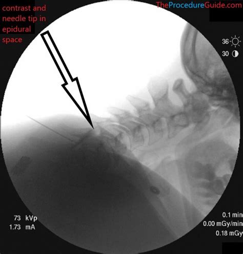 Fluoroscopic Guided Sitting Cervical Interlaminar Midline Epidural