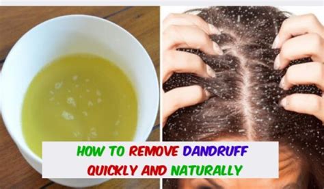 How To Remove Dandruff Quickly And Naturally Right Home Remedies