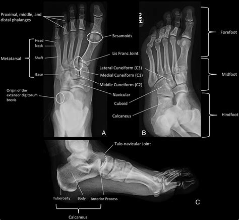 Osseous Injuries Of The Foot An Imaging Review Part 1 The Forefoot