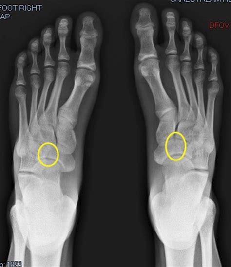 X Ray Of The Feet With Visible Fracture Lines Through The Navicular