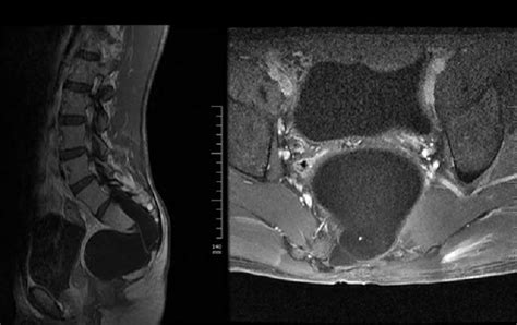 These Sagittal And Axial Mri Views Demonstrate The Pelvic Cystic Mass