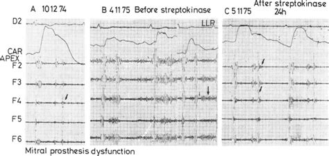 Case 5 Starr Edwards Mitral Prosthesis No 6120 Obstructive