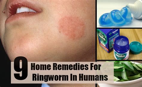 Home Remedies To Get Rid Of Lice Home Remedies Ringworm Humans