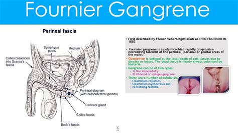 Diagnosis and treatment should be prompt and adequate. Fournier Gangrene causes,pathophysiology,features ...