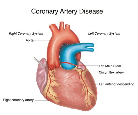 Liverpool Heart And Chest Hospital Coronary Artery Disease