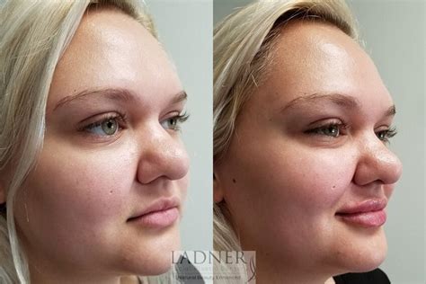 Dermal Fillers Before And After Photo Gallery Denver Co Ladner Facial Plastic Surgery