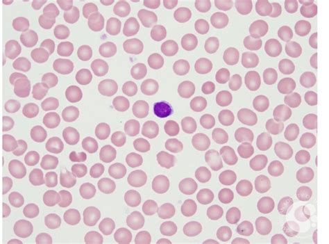 Normocytic Rbcs With Lymphocyte For Comparison