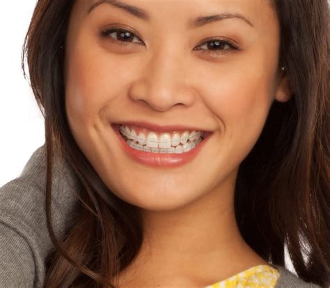 Cosmetic Braces Hydean Dental Practice
