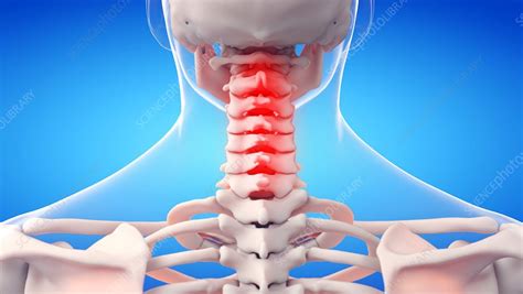 Painful Cervical Spine Illustration Stock Image F0349766