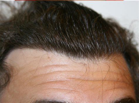 Hair transplantation is quite successful hair transplants performed in patients with these issues do not work well. image