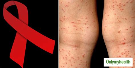 Are Rashes And Skin Conditions Associated With Hivaids Explains
