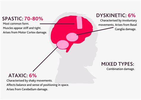 The human brain diagnosis of cp types of cp treatment and management of cp living with cp aging and cp preventing cp a parent's perspective research the professional team. Types of cerebral palsy - Cerebral Palsy Cymru