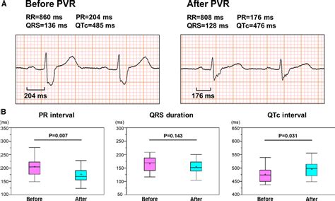 Prognostic Significance Of Pr Interval Prolongation In Adult Patients