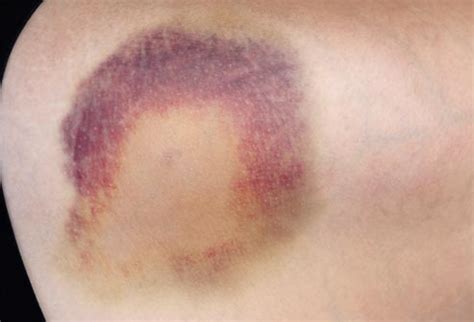 What Different Color Bruises Mean The Meaning Of Color