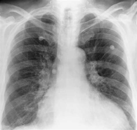 Plain Chest Radiogram Showing Typical Appearance Of Calcification