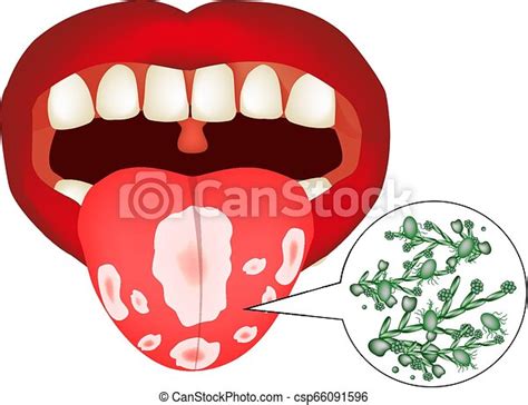 Oral Thrush Candidiasis On The Tongue Fungus In The Mouth