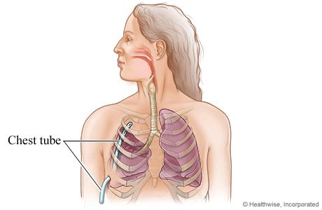 If the chest tube thoracostomy wound is not grossly infected or inflamed, it can be used as one of the nvats ports. Lung Surgery: Chest Tube | University of Michigan Health ...