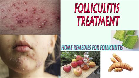 Home Remedies For Folliculitis Naturally Treat Folliculitis