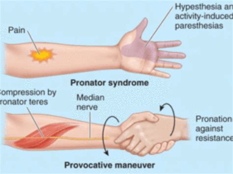 Pronator Teres Syndrome