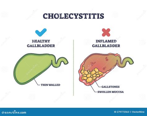 Cholecystitis As Inflamed Gallbladder Compared With Healthy Outline