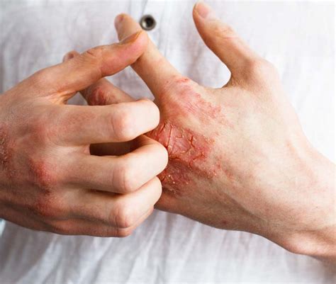 Eczema And Psoriasis Manchester Cheshire And Lancashire Dr Nicole