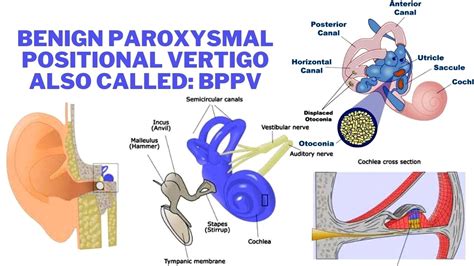Benign Paroxysmal Positional Vertigo Bppv Symptoms Causes